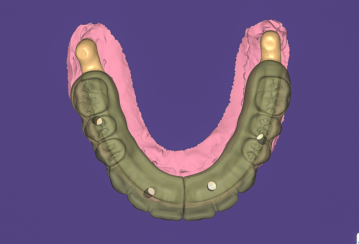 Pterygoid Implants Ventura, California California